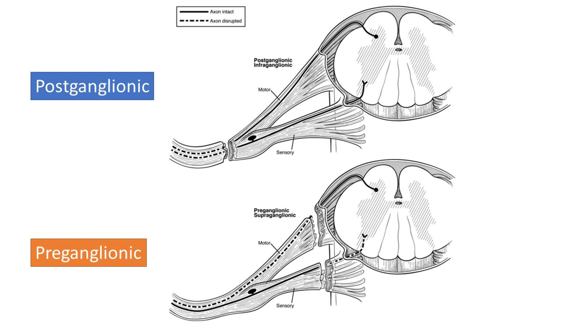 Brachial Plexus Injury – NIT Neurosurgery