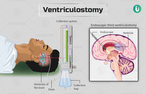 การดูแล ventriculostomy (EVD) เบื้องต้นสำหรับ Non-neurosurgeon: Practical Points